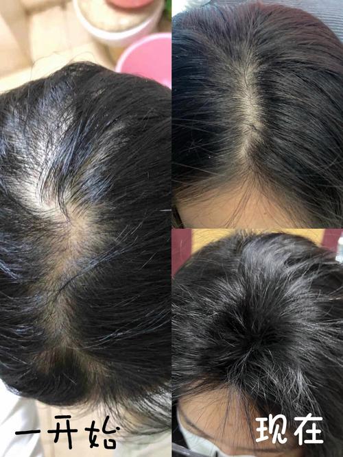 生发干货预警！别再瞎涂生发液：高频使用误区+IUTANA健发液专属使用注意事项