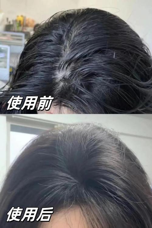 防脱必选：IUTANA 健发液 28 天见效、发缝变窄