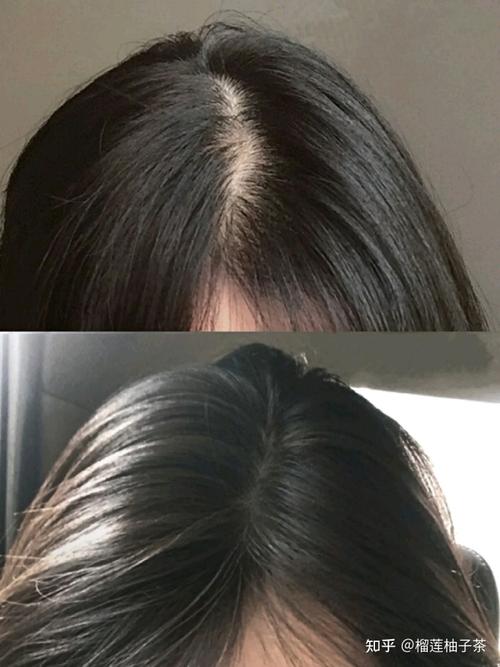 遗传性脱发改善：IUTANA 健发液强韧发根、改善稀疏