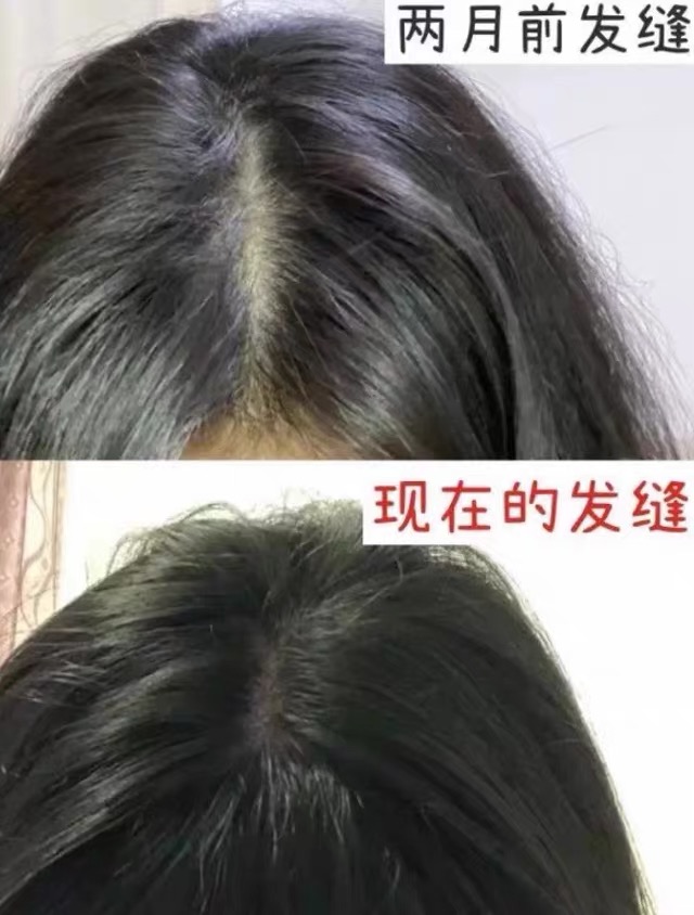 生发液怎么选才有效？避开这些常见选购误区，IUTANA健发液帮你稳守发量