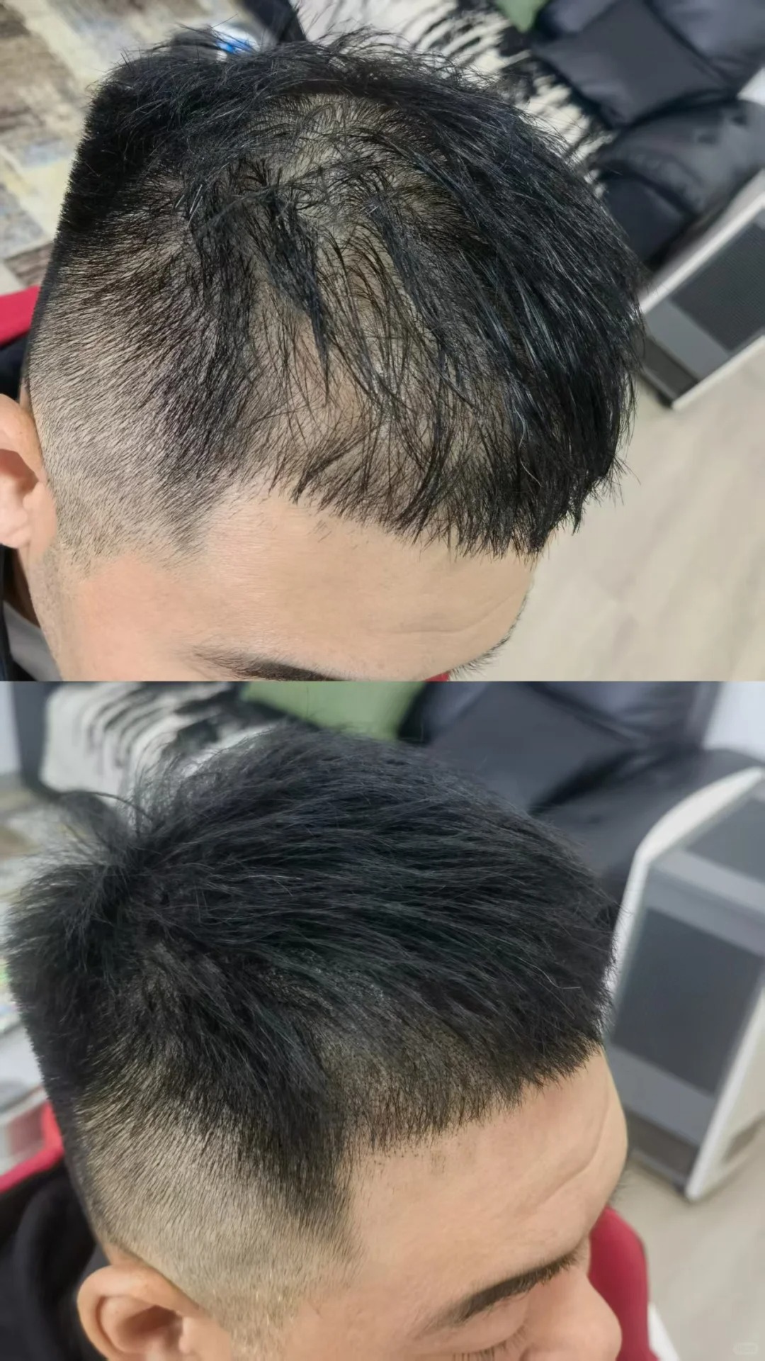 发量稀少加密的效果图_3_上海麦田SMP纹发_来自小红书网页版.jpg